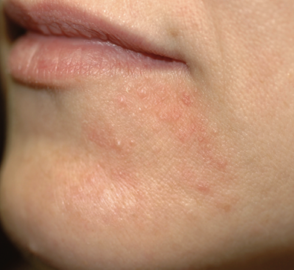 Perioral dermatitt